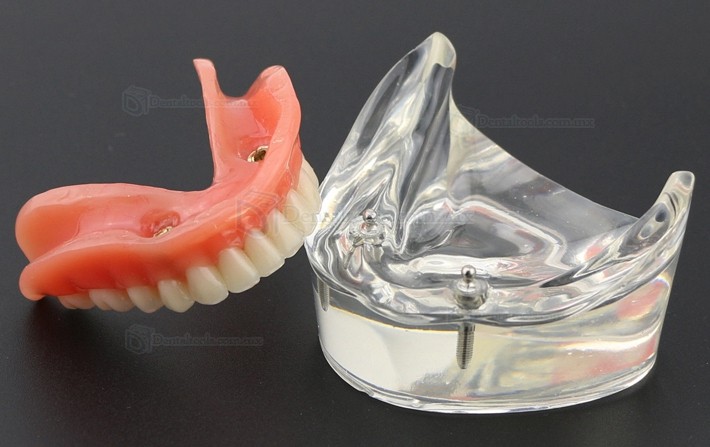 Dental Inferiores Modelo de Implante de sobredentadura 2 Implantes Demostración Modelo 6002 01